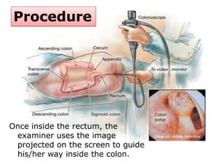 Procedure
Once inside the rectum, the
examiner uses the image
projected on the screen to guide
his/her way inside the colon.
 