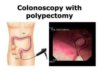Colonoscopy with
polypectomy
 