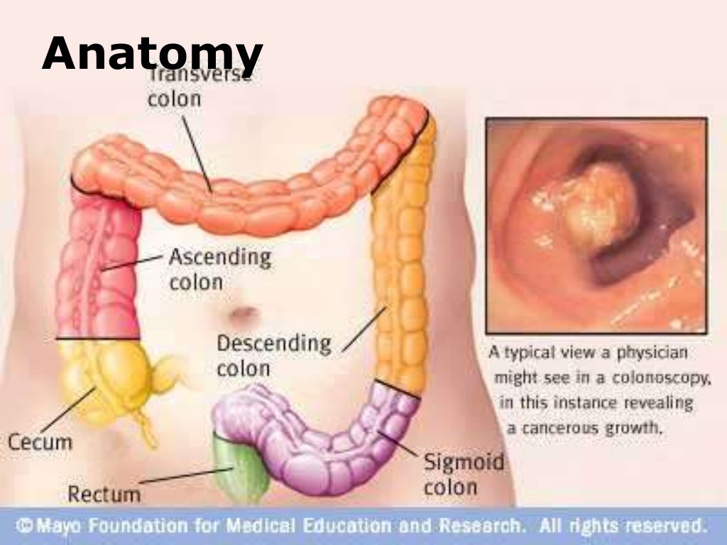 Colonoscopy With Polypectomy Colonoscopy with polypectomy