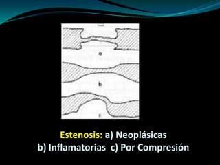 Estenosis: a) Neoplásicas
b) Inflamatorias c) Por Compresión
 