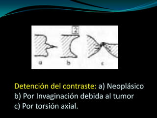 Detención del contraste: a) Neoplásico
b) Por Invaginación debida al tumor
c) Por torsión axial.
 