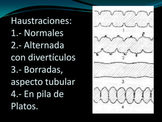 Haustraciones:
1.- Normales
2.- Alternada
con divertículos
3.- Borradas,
aspecto tubular
4.- En pila de
Platos.
 