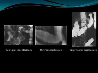 Multiples indentaciones   Ulceras superficiales   Impresiones digitiformes
 