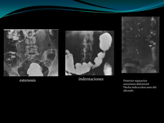 estenosis   indentaciones   Posterior reparacion
                            aneurisma abdominal
                            Flecha indica colon sano del
                            afectado
 