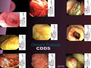 Praful Vahoniya
Paper-421
L. M. College of Pharmacy
Ahmedabad
Chron’s Disease
(5/75)
 