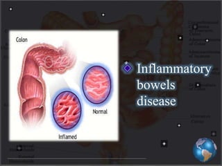 Inflammatory
bowels
disease
 