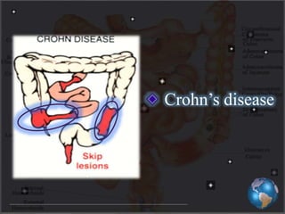 Crohn’s disease
 