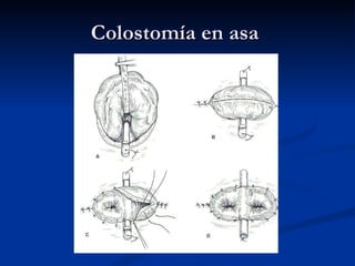 Colostomía en asa