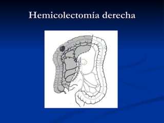 Hemicolectomía derecha