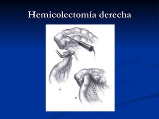 Hemicolectomía derecha