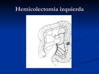 Hemicolectomía izquierda
