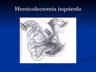 Hemicolectomia izquierda