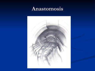 Anastomosis