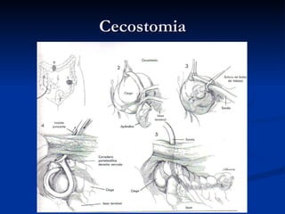 Cecostomia
