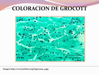 Imagen: http://www.inclinica.org/img/caso9_3.jpg
COLORACION DE GROCOTT
 