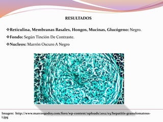 RESULTADOS
Reticulina, Membranas Basales, Hongos, Mucinas, Glucógeno: Negro.
Fondo: Según Tinción De Contraste.
Nucleos: Marrón Oscuro A Negro
Imagen: http://www.marcosgodoy.com/foro/wp-content/uploads/2012/03/hepatitis-granulomatous-
i.jpg
 
