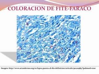 Imagen: http://www.actasdermo.org/es/lepra-puesta-al-dia-definicion/articulo/90220985/?pubmed=true
COLORACION DE FITE-FARACO
 
