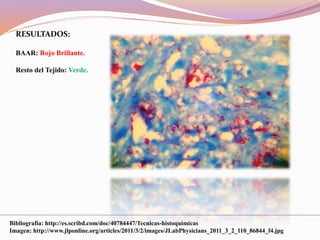 RESULTADOS:
BAAR: Rojo Brillante.
Resto del Tejido: Verde.
Bibliografía: http://es.scribd.com/doc/40784447/Tecnicas-histoquimicas
Imagen: http://www.jlponline.org/articles/2011/3/2/images/JLabPhysicians_2011_3_2_110_86844_f4.jpg
 