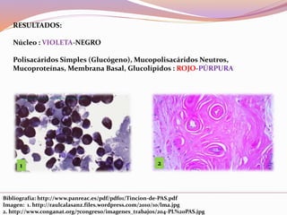 Bibliografía: http://www.panreac.es/pdf/pdf01/Tincion-de-PAS.pdf
Imagen: 1. http://raulcalasanz.files.wordpress.com/2010/10/lma.jpg
2. http://www.conganat.org/7congreso/imagenes_trabajos/204-PL%20PAS.jpg
RESULTADOS:
Núcleo : VIOLETA-NEGRO
Polisacáridos Simples (Glucógeno), Mucopolisacáridos Neutros,
Mucoproteínas, Membrana Basal, Glucolípidos : ROJO-PÚRPURA
1 2
 