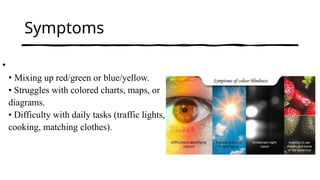 color blindness (color vision deficiency) | PPTX