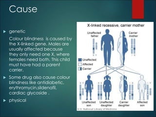 Cause 
 genetic 
Colour blindness is caused by 
the X-linked gene. Males are 
usually affected because 
they only need one X, where 
females need both. This child 
must have had a parent 
carrier. 
 Some drug also cause colour 
blindness like antidiabetic, 
erythromycin,sildenafil, 
cardiac glycoside . 
 physical 
 