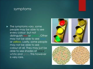 symptoms 
 The symptoms vary. some 
people may be able to see 
every colour but not 
distinguish red or green. Other 
may not be able to see blue 
or yellow. Lastly, some people 
may not be able to see 
colour at all. They may just be 
able to see shades of black, 
white and gray. This however 
is very rare. 
 
