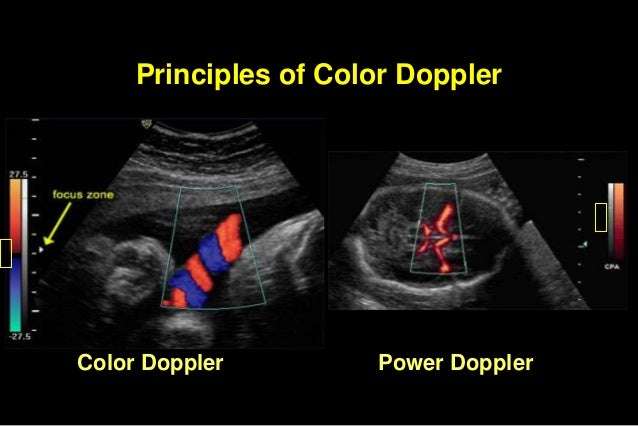 Color doppler in fetal hypoxia
