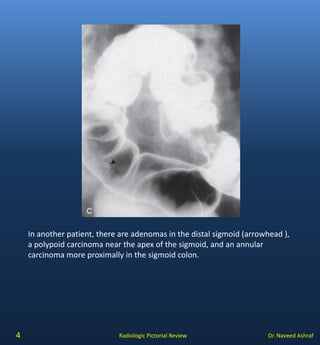 Coloretcal carcinoma | PDF