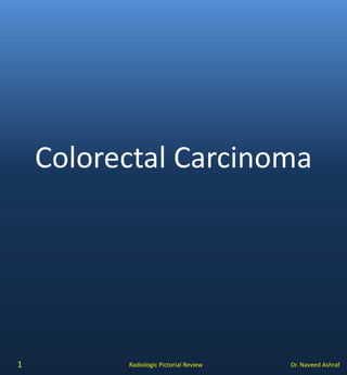 Dr. Naveed AshrafRadiologic Pictorial Review
Colorectal Carcinoma
1
 