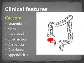 Caecum
 Anaemia
 Mass
 Dark stool
 Obstruction
 Dyspepsia
 Diarrhoea
 Appendicitis
 