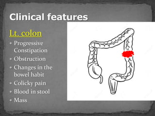 Lt. colon
 Progressive
Constipation
 Obstruction
 Changes in the
bowel habit
 Colicky pain
 Blood in stool
 Mass
 