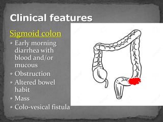 Sigmoid colon
 Early morning
diarrhea with
blood and/or
mucous
 Obstruction
 Altered bowel
habit
 Mass
 Colo-vesical fistula
 