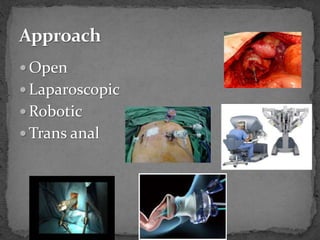  Open
 Laparoscopic
 Robotic
 Trans anal
 