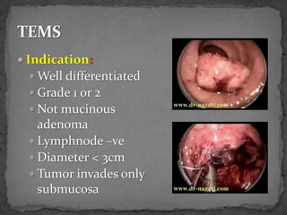  Indication:
 Well differentiated
 Grade 1 or 2
 Not mucinous
adenoma
 Lymphnode –ve
 Diameter < 3cm
 Tumor invades only
submucosa
 
