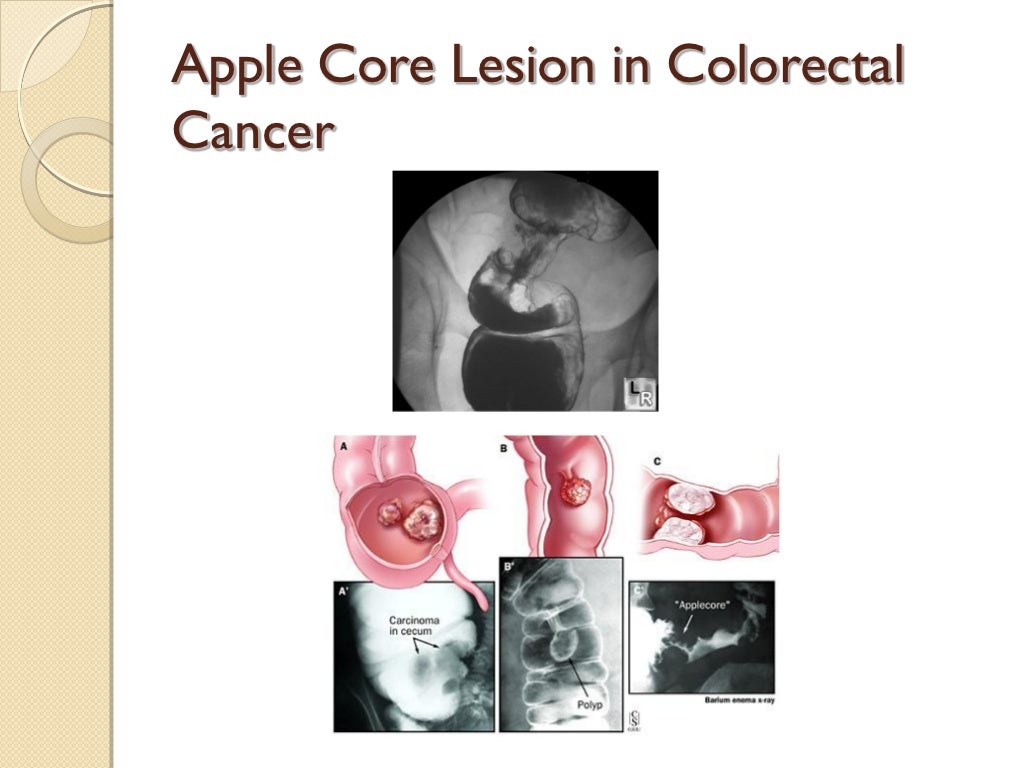 Colorectal Cancer