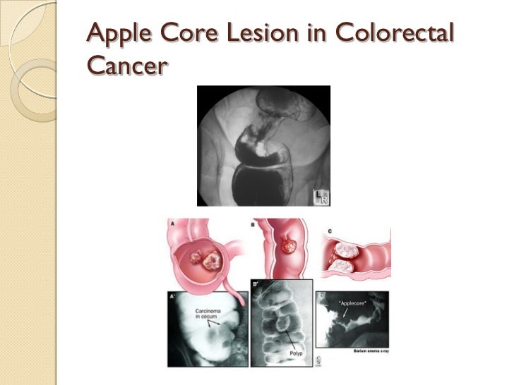 Colorectal Cancer