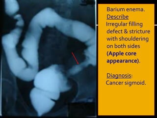 Colorectal cancer | PPTX