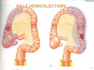 RT,LT HEMICOLECTOMY
124
 