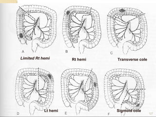 Limited Rt hemi Rt hemi Transverse cole
Lt hemi Sigmoid cole
127
 