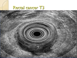 Rectal cancer T3Rectal cancer T3
47
 