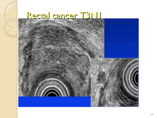 Rectal cancer T3N1Rectal cancer T3N1
48
 