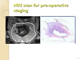 MRI scan for pre-operativeMRI scan for pre-operative
stagingstaging
49
 