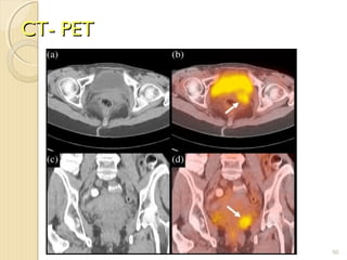CT- PETCT- PET
50
 