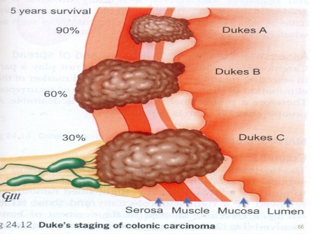 colorectal cancer colon cancer tumor size