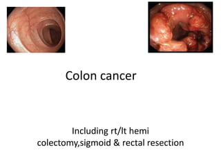 Colon cancer
Including rt/lt hemi
colectomy,sigmoid & rectal resection
 