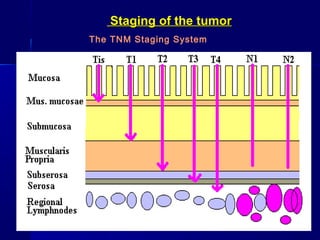 Staging of the tumorStaging of the tumor
The TNM Staging System
 