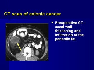 CT scan of colonic cancerCT scan of colonic cancer
 Preoperative CT -Preoperative CT -
cecal wallcecal wall
thickening an...