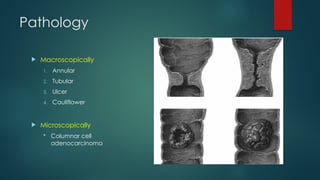 Colorectal Carcenoma - Copy by undergraduate .pptx