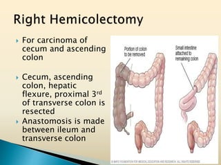 For carcinoma of
cecum and ascending
colon
 Cecum, ascending
colon, hepatic
flexure, proximal 3rd
of transverse colon is
resected
 Anastomosis is made
between ileum and
transverse colon
 