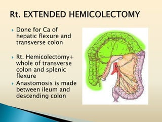 Done for Ca of
hepatic flexure and
transverse colon
 Rt. Hemicolectomy+
whole of transverse
colon and splenic
flexure
 Anastomosis is made
between ileum and
descending colon
 